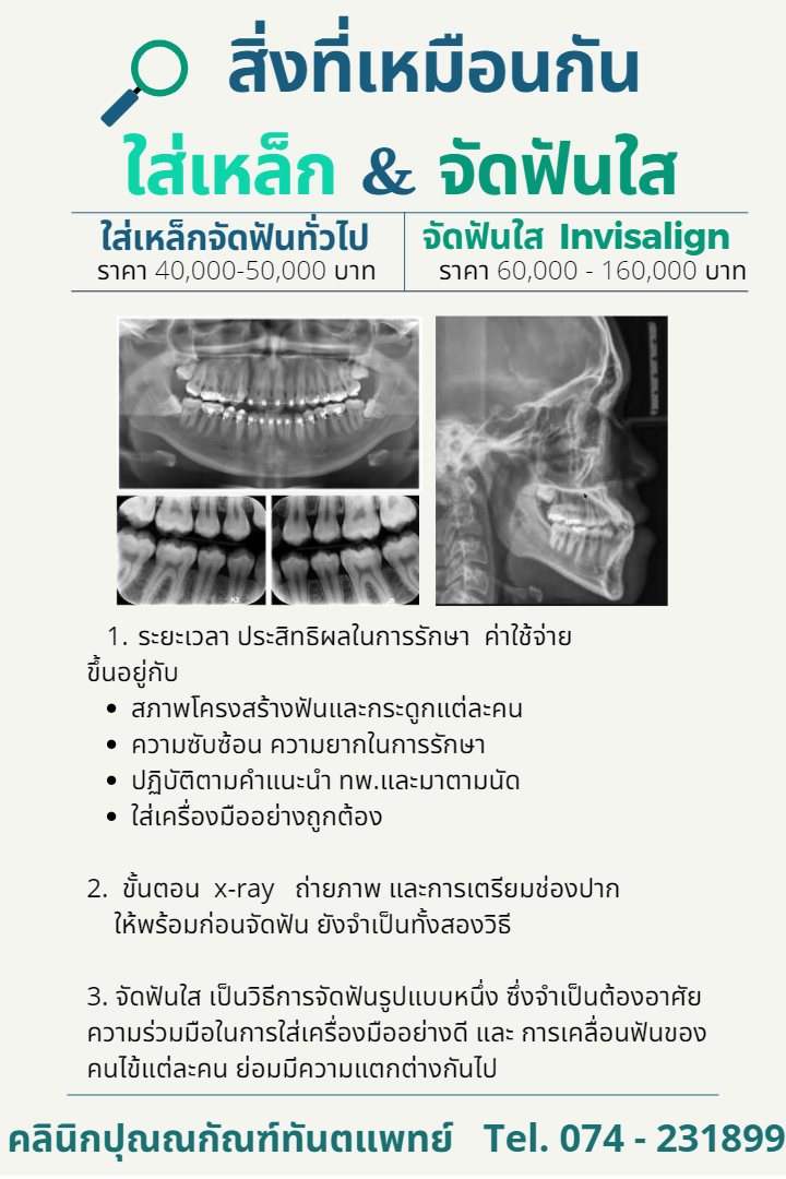 การจัดฟันใส หาดใหญ่