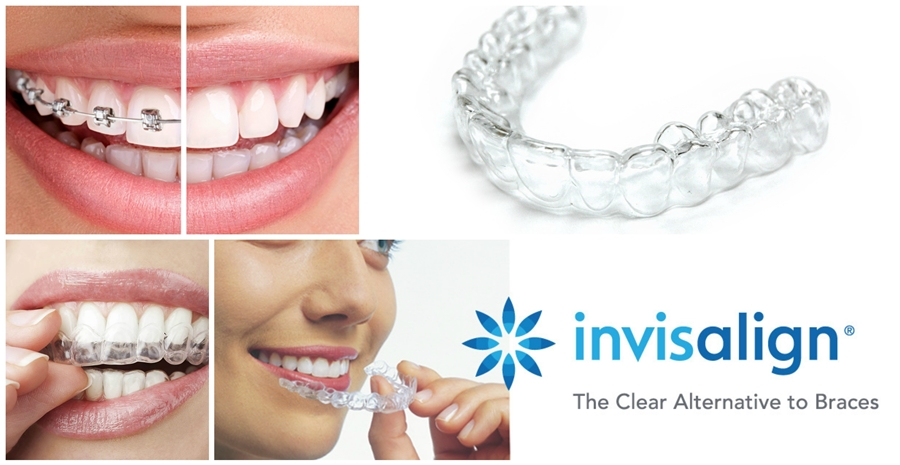 ปุณณกัณฑ์ทันตแพทย์ จัดฟันใส invisalign หาดใหญ่ 